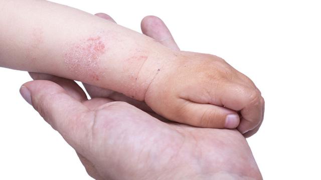 Mengenal Penyakit Dermatitis, Gejala, dan Cara Pencegahannya