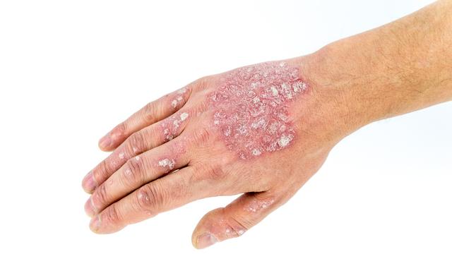 Mengenal Penyakit Dermatitis, Gejala, dan Cara Pencegahannya